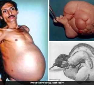 In Rare Medical Condition, Nagpur Man Was 'Pregnant' With Twin For 36 Years | Baaghi TV