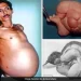 In Rare Medical Condition, Nagpur Man Was 'Pregnant' With Twin For 36 Years | Baaghi TV