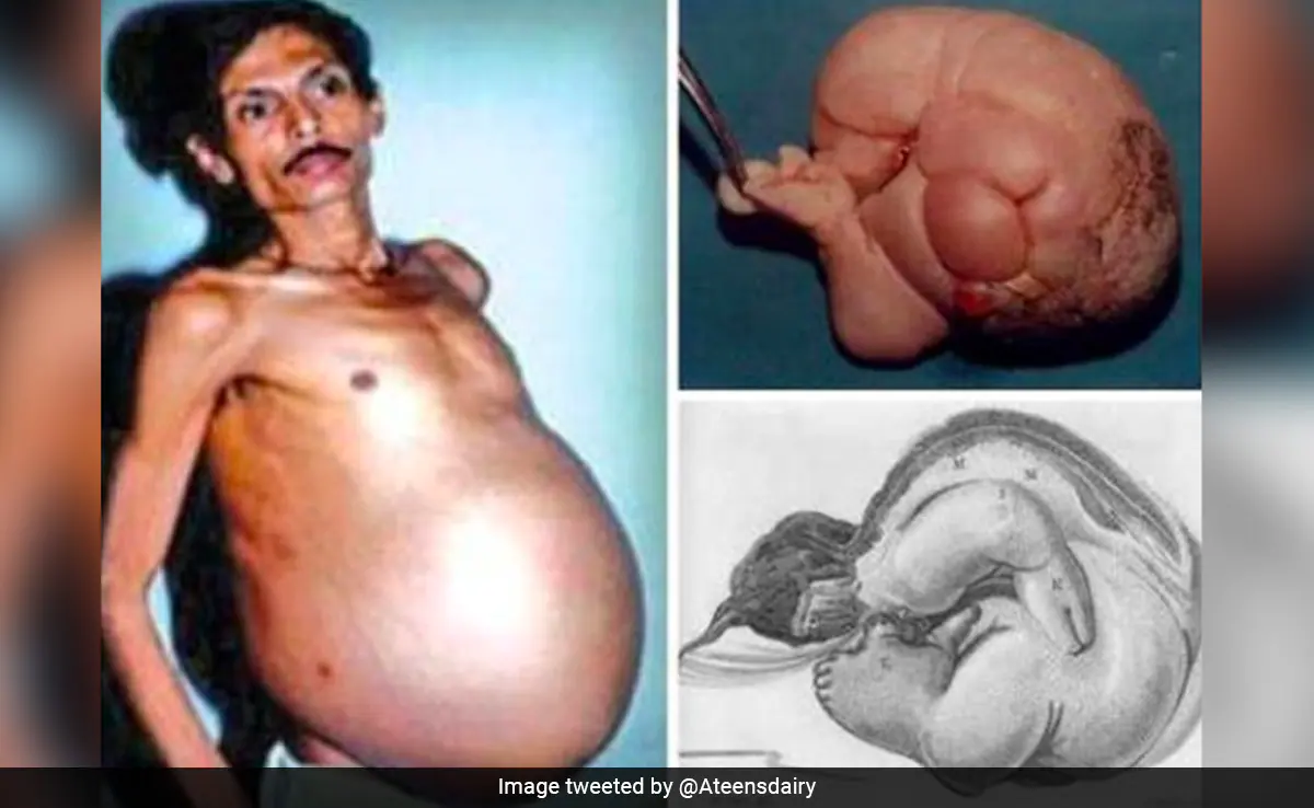 In Rare Medical Condition, Nagpur Man Was 'Pregnant' With Twin For 36 Years | Baaghi TV